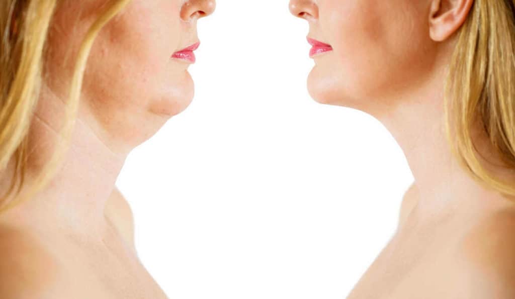 Double Chin treatment Gosport before and after results