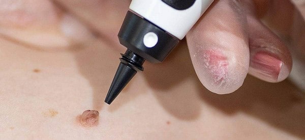 After Skin Tag Removal Gosport