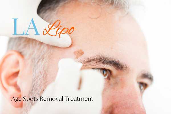 What Are the Most Effective Treatments for Age Spots Gosport?