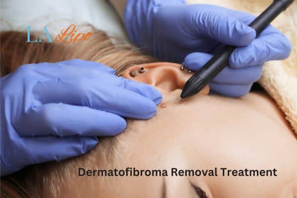 Dermatofibroma Removal Treatment Gosport