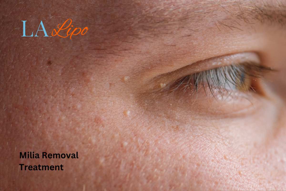 Cryopen Milia Removal: Is It the Easiest and Safest Option Gosport?