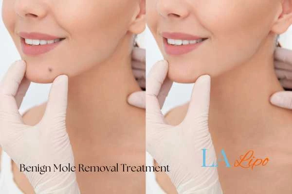 woman's before and after mole removal Gosport results