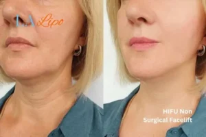 hi-fu for wrinkles Gosport before and after results