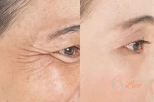 Before and after results of woman - HI-fu wrinkles reduction treatment Gosport