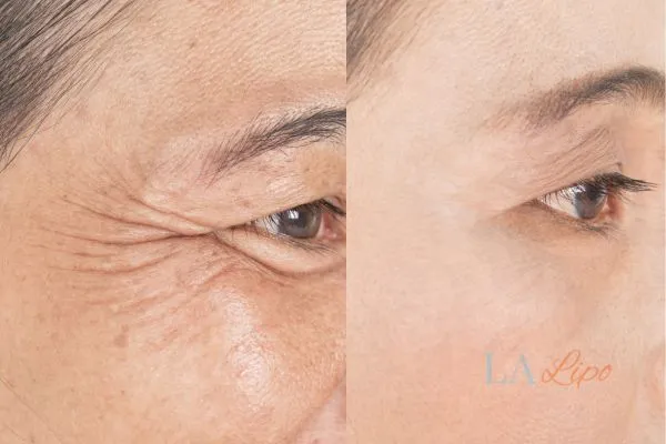 Before and after results of woman - HI-fu wrinkles reduction treatment Gosport