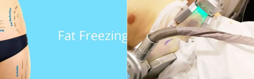 Fat freezing Gosport on multiple areas of the body