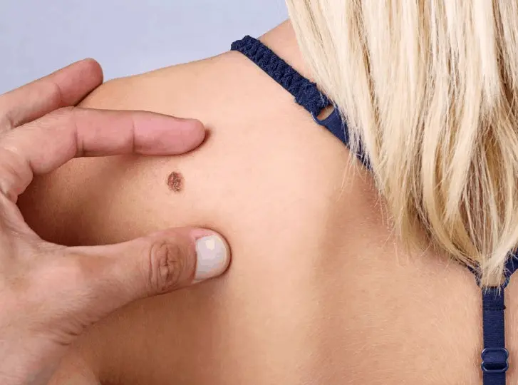 woman having mole removal Gosport consultation before treatment.