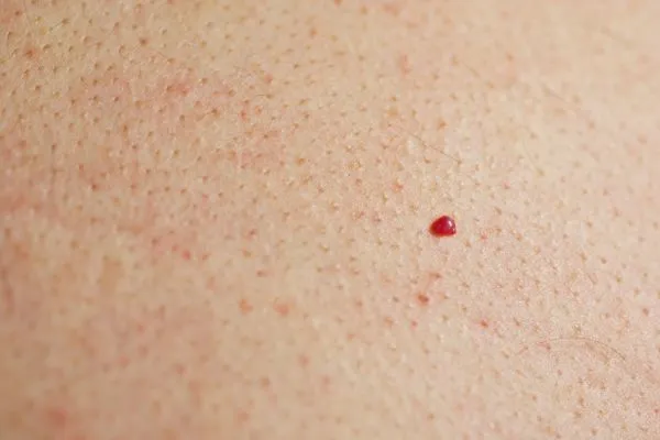 close up of a cherry angioma Gosport