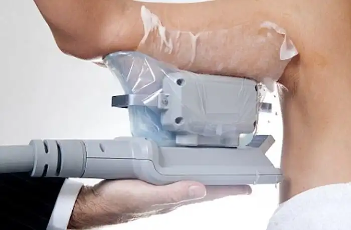 Picture of fat freezing Gosport on the upper arms.