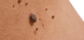image of a skin tag Gosport