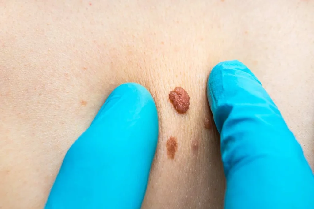 Consultant examining a skin tag Gosport