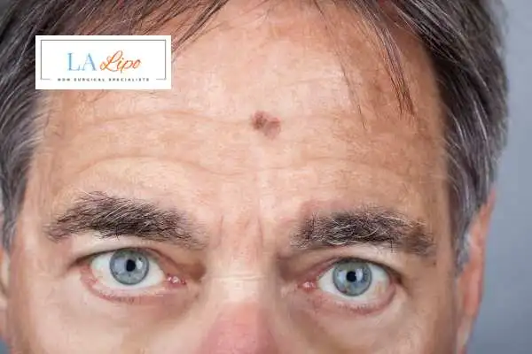 Solar Lentigo Removal Gosport image of man with mark on his forehead