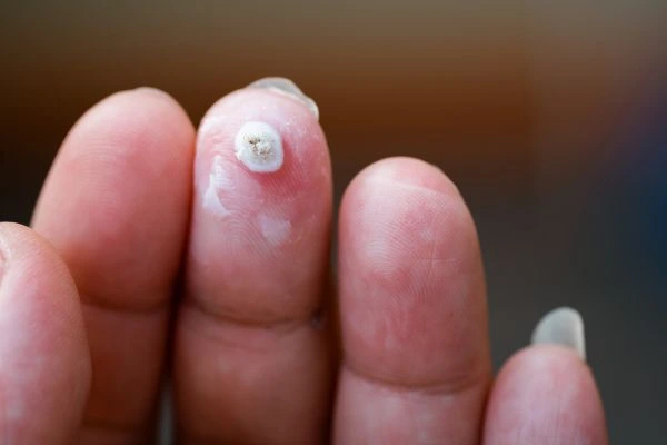 wart on person finger - cryotherapy to treat from LA LIPO Gosport