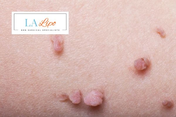 Does cryopen skin tag removal Gosport hurt? Find out now call our team today!