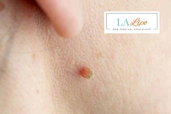 Book skin tag removal Gosport today speak to our team now!