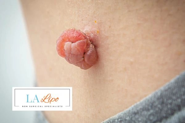 Interested in skin tag removal Gosport? Concerned about the pain? Find out more today!