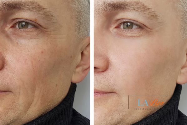 See the amazing results of Morpheus8 Treatment Gosport!