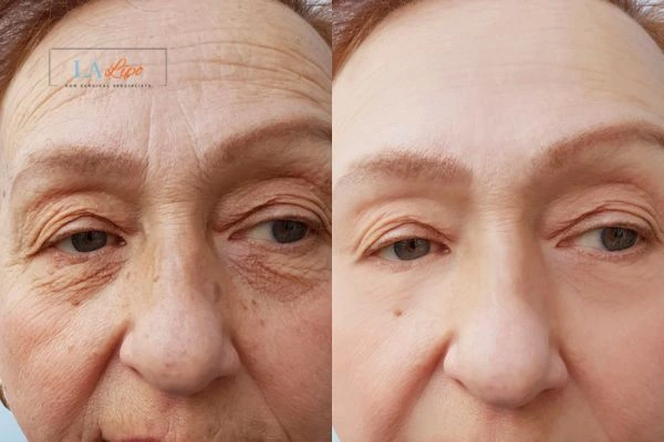The powerful benefits of Morpheus8 Treatment Gosport - Call Our team today!