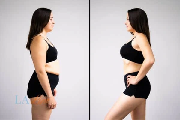 Picture of womans before and after using LA-EMS body sculpting to improve her core strength Gosport