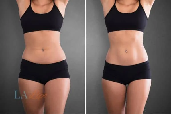 before and after results of non-surgical treatment to help a woman's body image and mental health Gosport