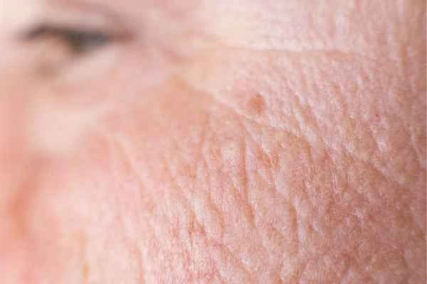 close up picture of a woman's face showing an age spot Gosport