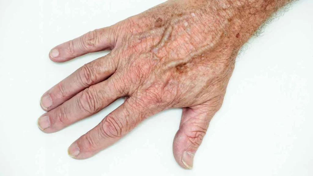 Male hand showing age spot Gosport