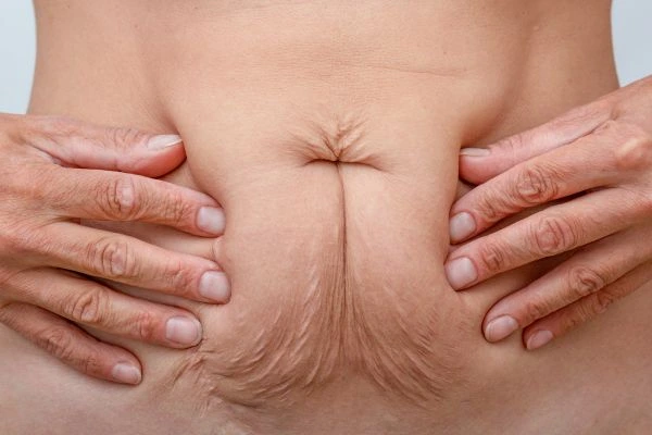 Image of a woman's stomach with loose skin - example of skin tightening Gosport options